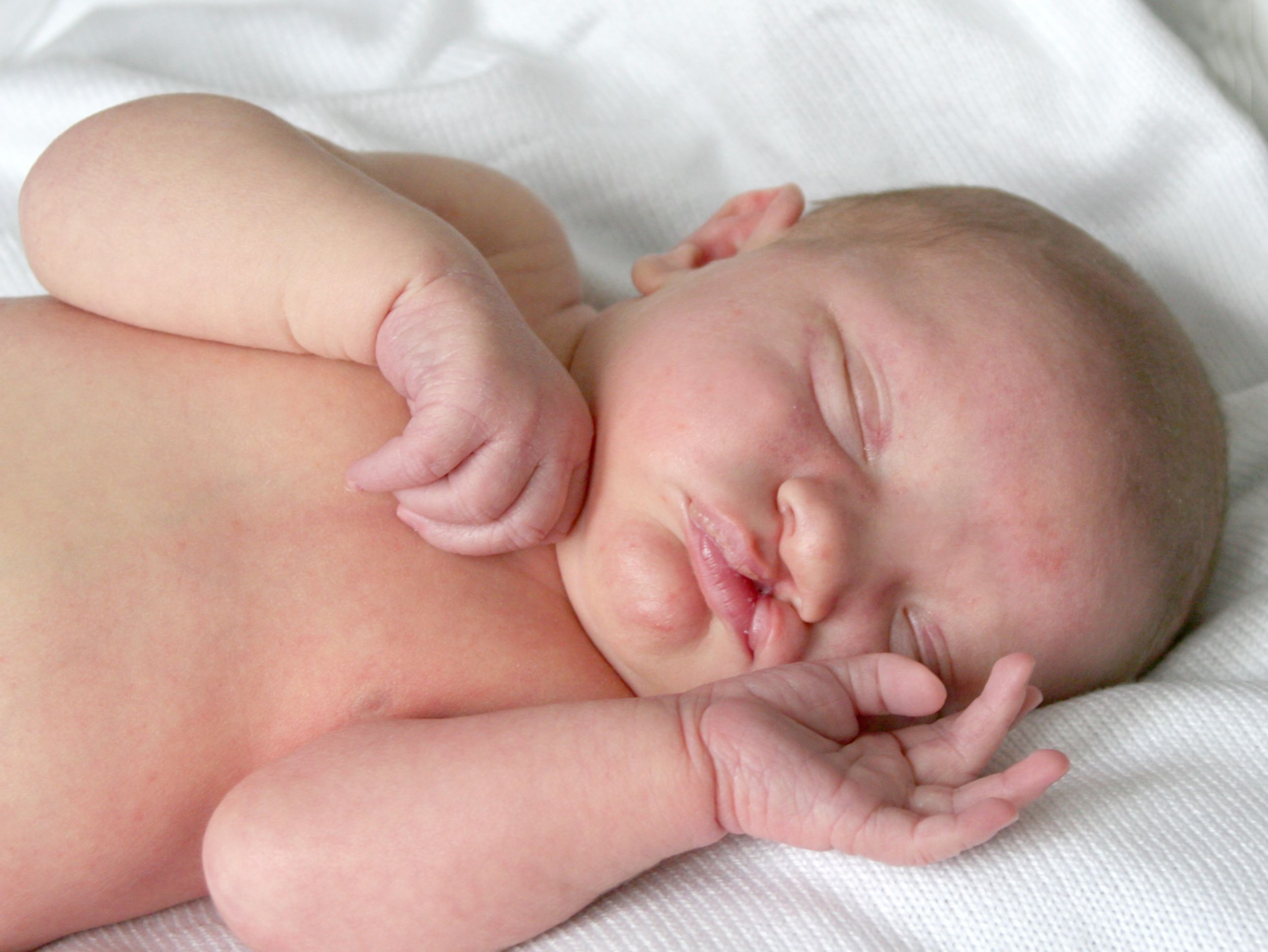 Bébé avec fente labio-palatine