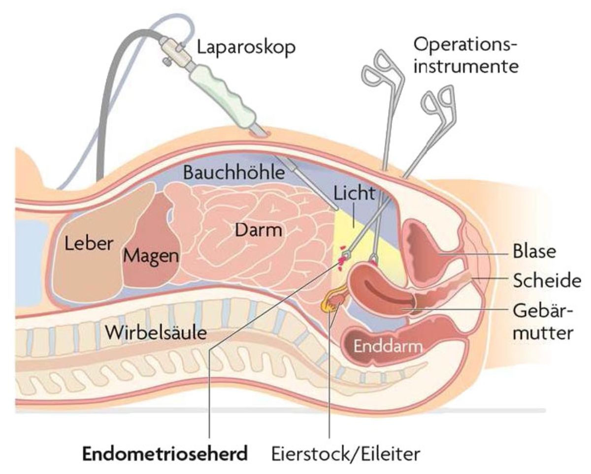 Endometriose–Herd