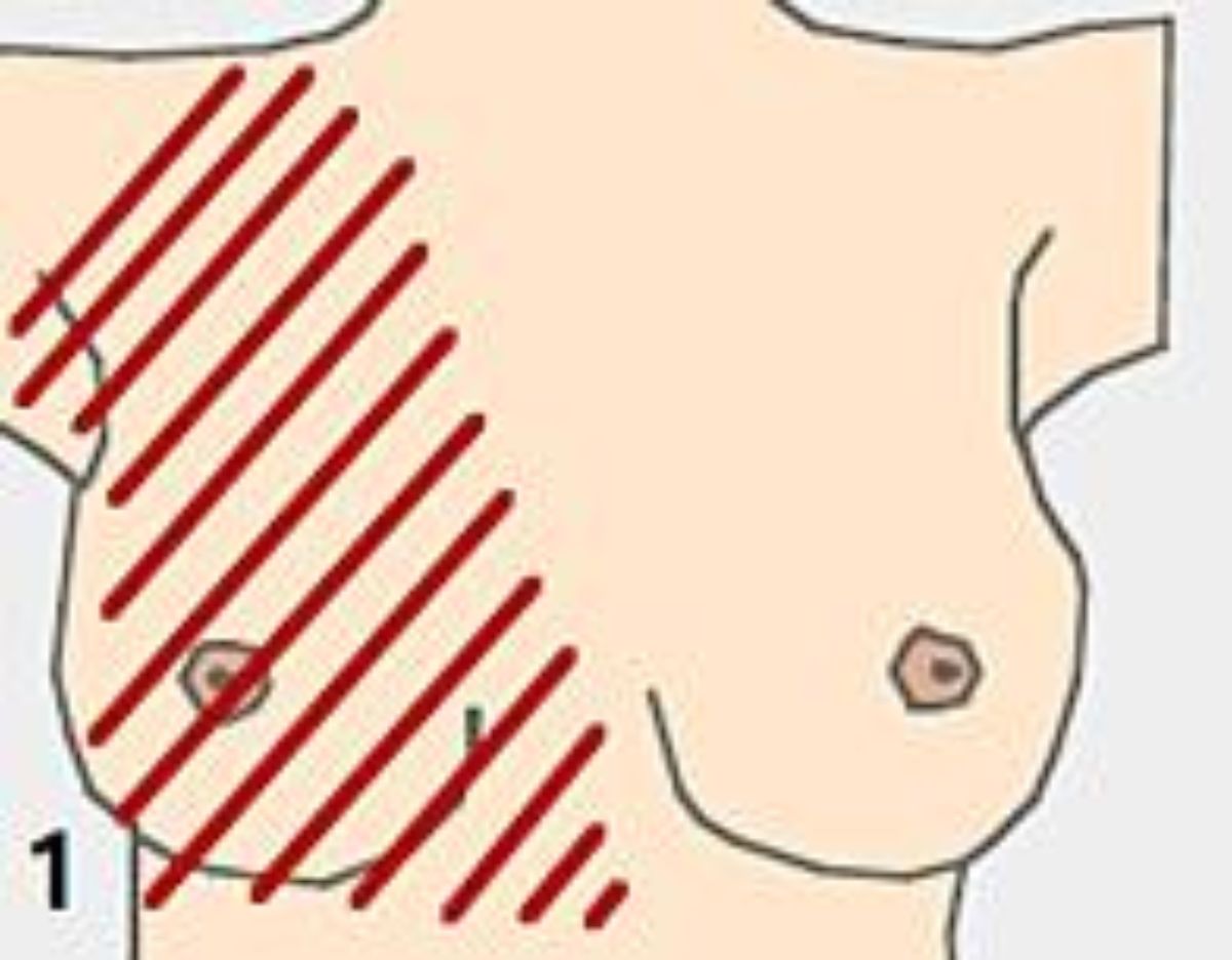 Representation of a breast