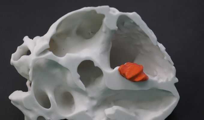 Ein dreidimensionales Modell eines Herzens mitsamt Tumor