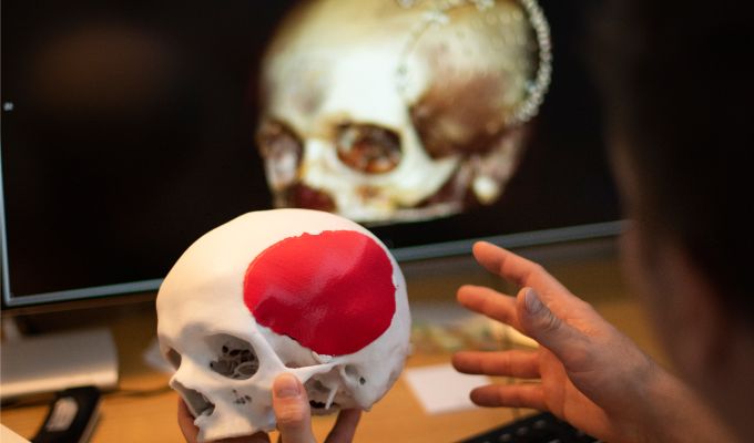 3D-Modell eines künstlichen Implantats einer Schädelplatte