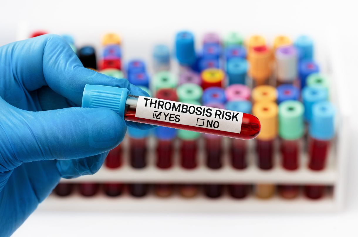 Nahaufnahme Reagenzglas mit Aufschrift "Thrombosis Risk"