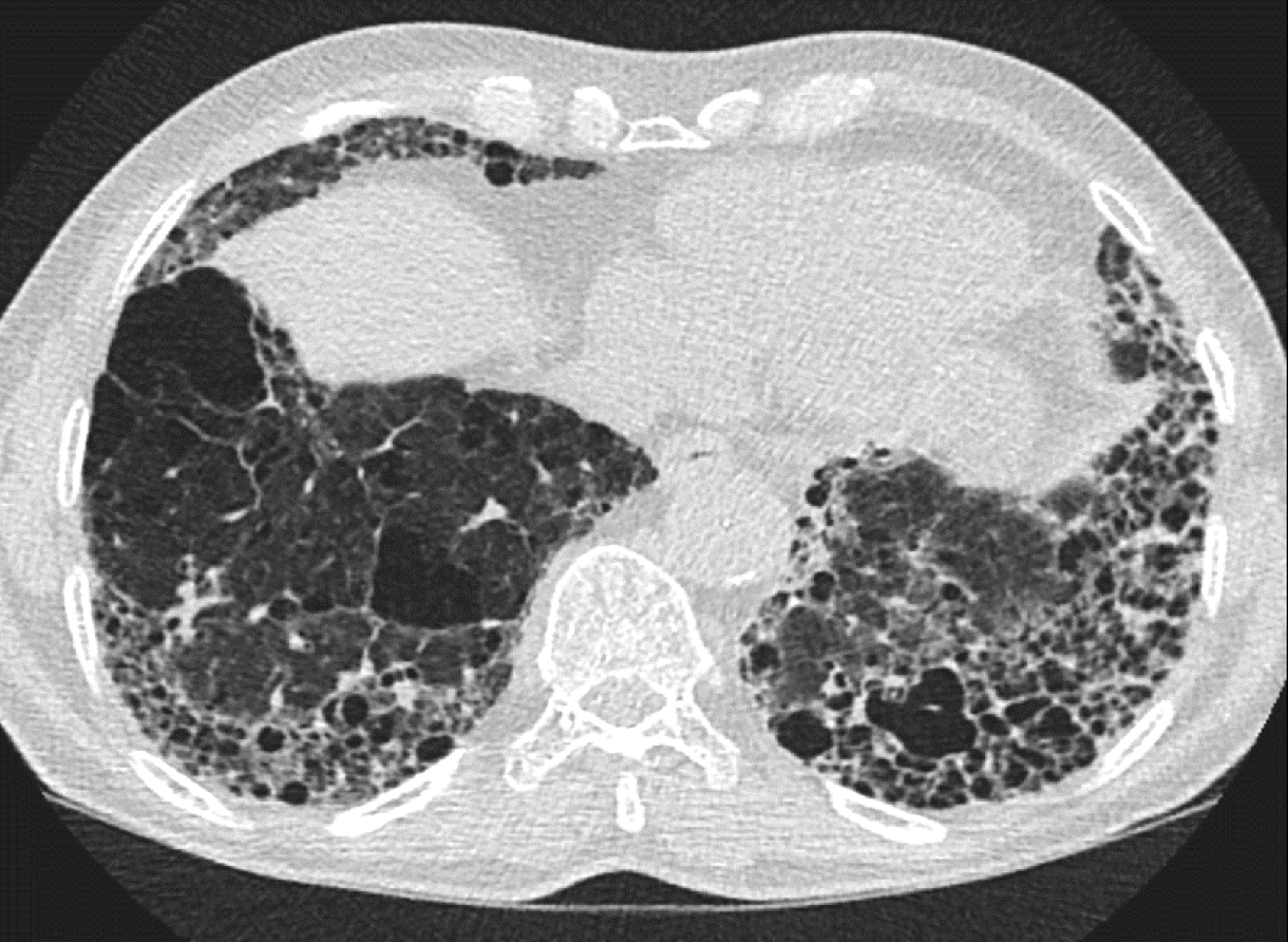 CT-Aufnahme einer interstitiellen Lungenkrankheit
