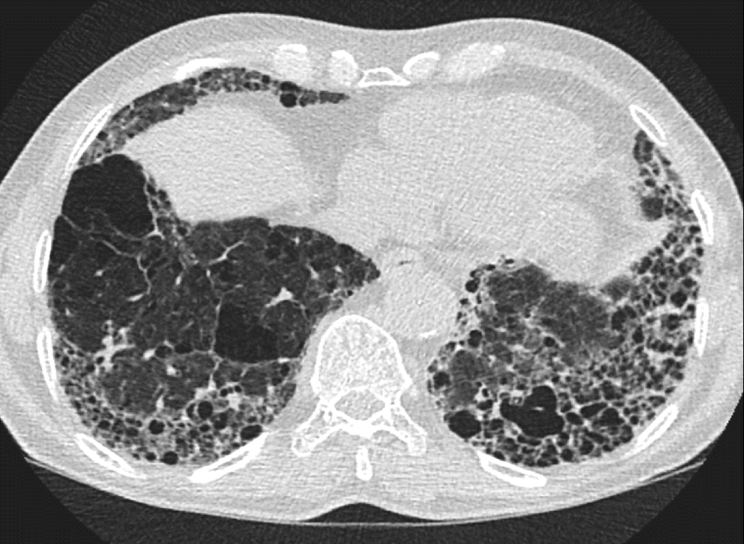 CT image of an interstitial lung disease