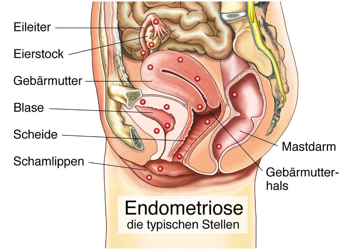 Bauchspiegelung