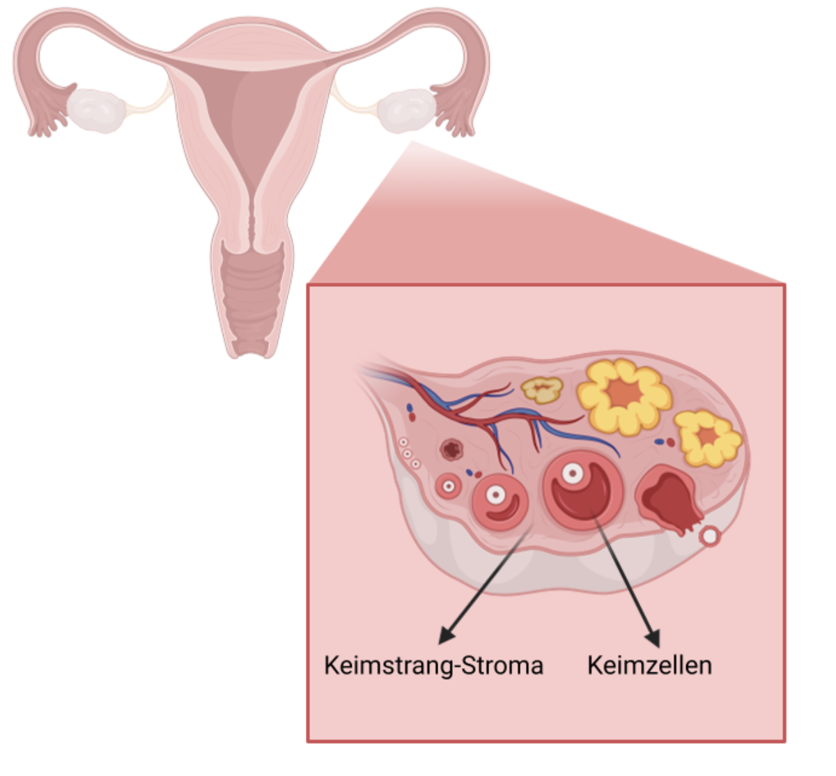 Embryonale Eierstocktumore 