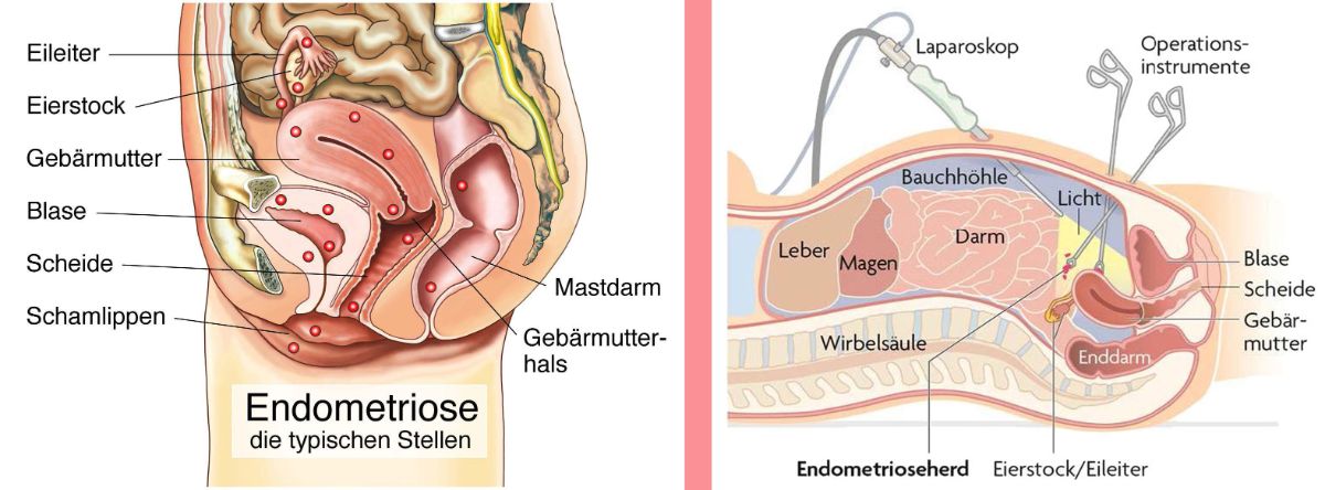 Grafik des Frauenunterleibs mit gekennzeichneten Organen und Hinweis auf den Endometriosenherd