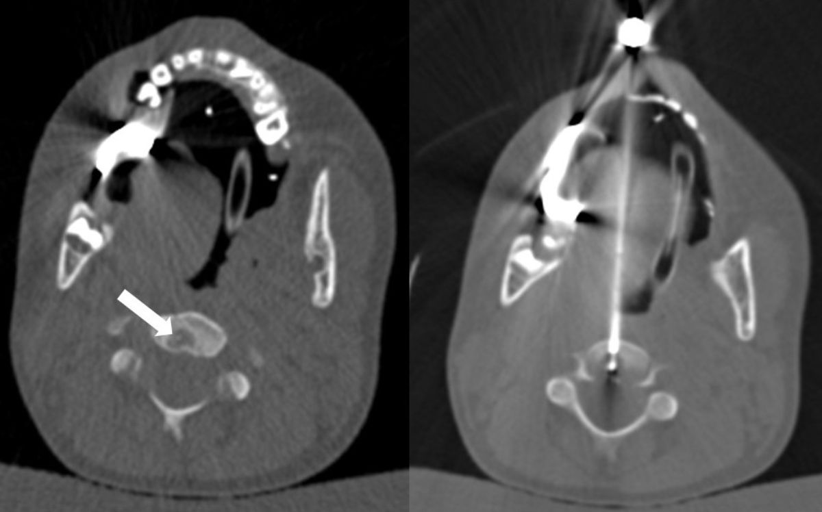 Computertomografie der erfolgreichen Radiofrequenzablation des Osteoidosteoms des jungen Patienten.