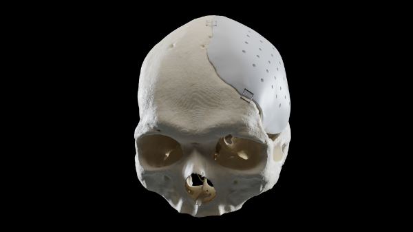 University Hospital Basel achieved a new first in August by implanting a patient with an artificial calvaria (skull cap), produced specifically for him in-house at USB. After many years of research and development, USB has succeeded in becoming the first hospital in Europe to produce 3D-printed implants that meet the requirements of international standards for medical devices.  